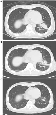 Effective Treatment With Afatinib of Lung Adenocarcinoma With Leptomeningeal Metastasis Harboring the Exon 18 p.G719A Mutation in the EGFR Gene Was Detected in Cerebrospinal Fluid: A Case Report